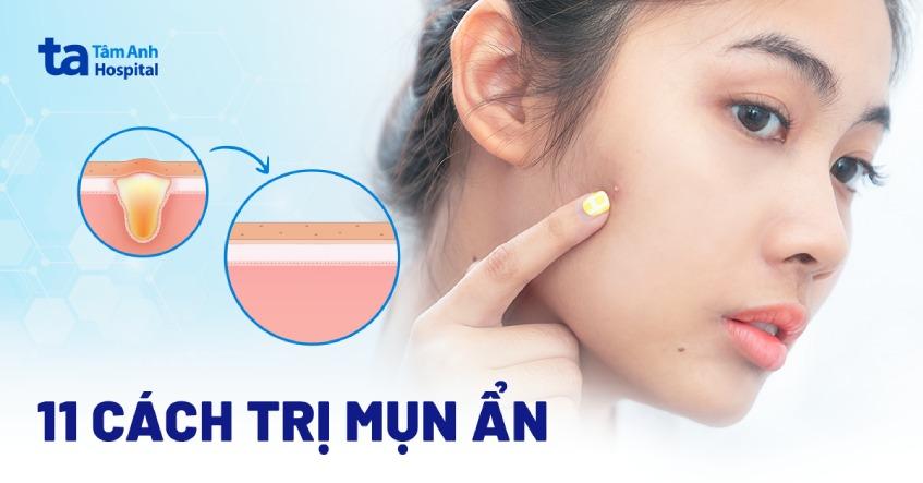 Các bước ngăn ngừa mụn trên trán tái phát như vệ sinh da, chế độ ăn, quản lý stress, chọn sản phẩm phù hợp.